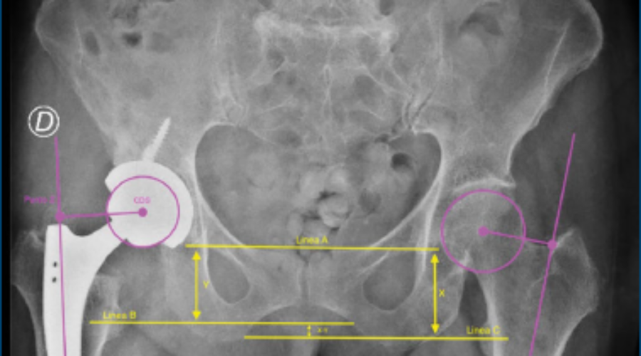 Utilizzo di Spaziatore Cementato rispetto a Procedura di Girdlestone nel Trattamento Two-Stage delle Infezioni Periprotesiche dell’Artroprotesi dell’Anca