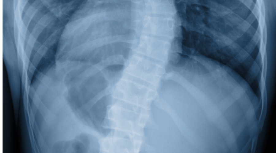 Aste Allungabili Magneticamente Controllate per Correzione di Gravi Curve Spinali nei Bambini