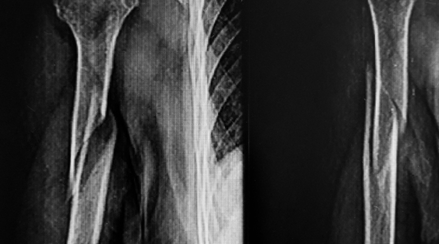 Sintomi e tempi di guarigione della frattura dell’omero